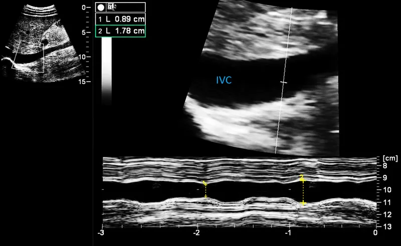 IVC ultrasound with respiratory variation