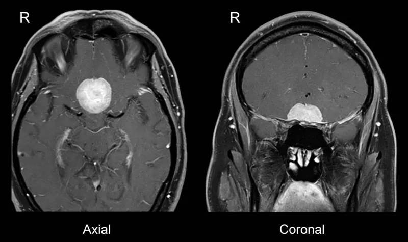 Axial and Coronal MRI of Skull Base Meningioma