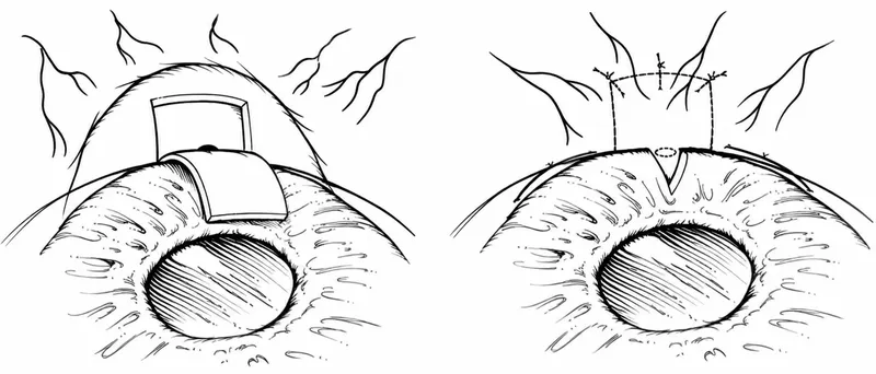Trabeculectomy surgical technique diagram