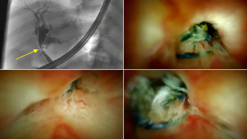 Biliary Spyglass cholangioscopy of cholangiocarcinoma