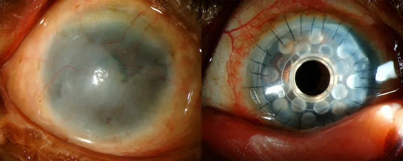 Severe SJS/OCP with keratoprosthesis