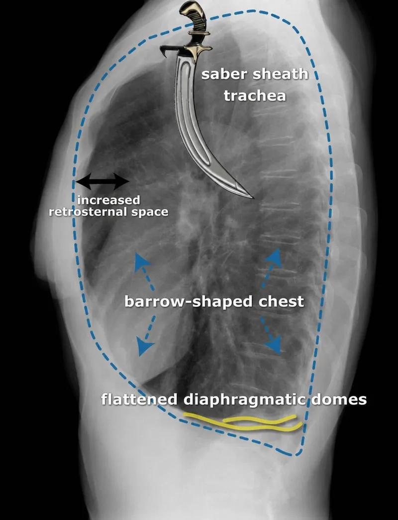 Chest X-ray: COPD hyperinflation signs