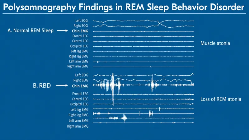 Polysomnography: Normal REM sleep vs. RBD