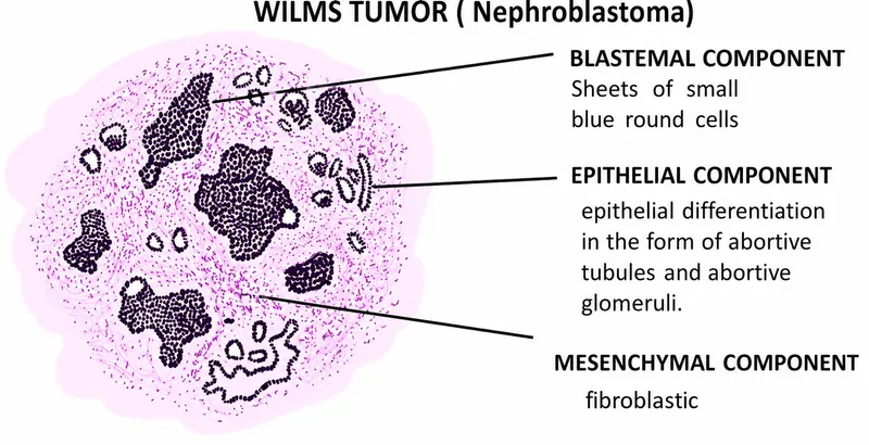 Triphasic Wilms Tumor Histopathology