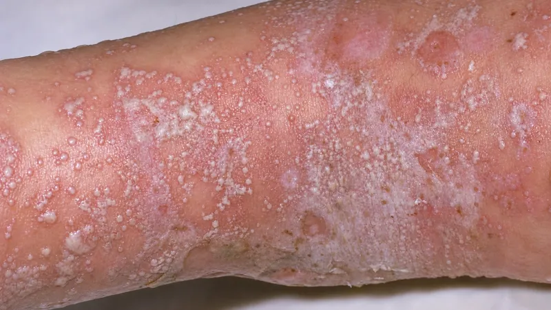 Generalized pustular psoriasis with lakes of pus
