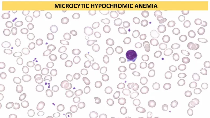 Peripheral smear: microcytic hypochromic anemia