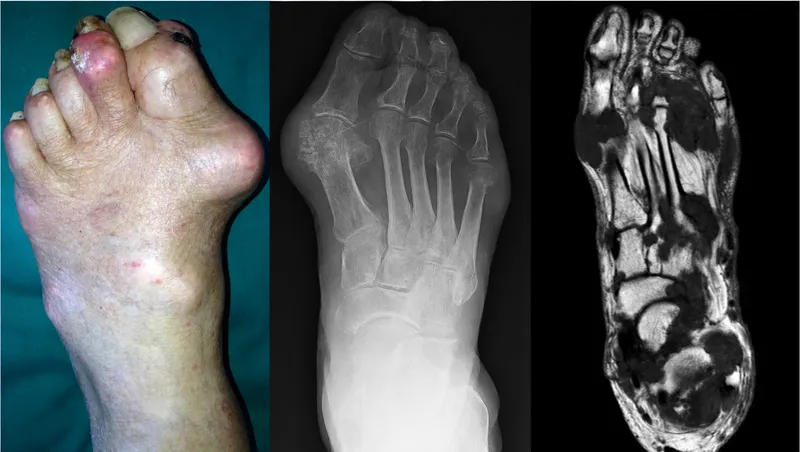 Gouty arthritis: Clinical, X-ray, and MRI findings