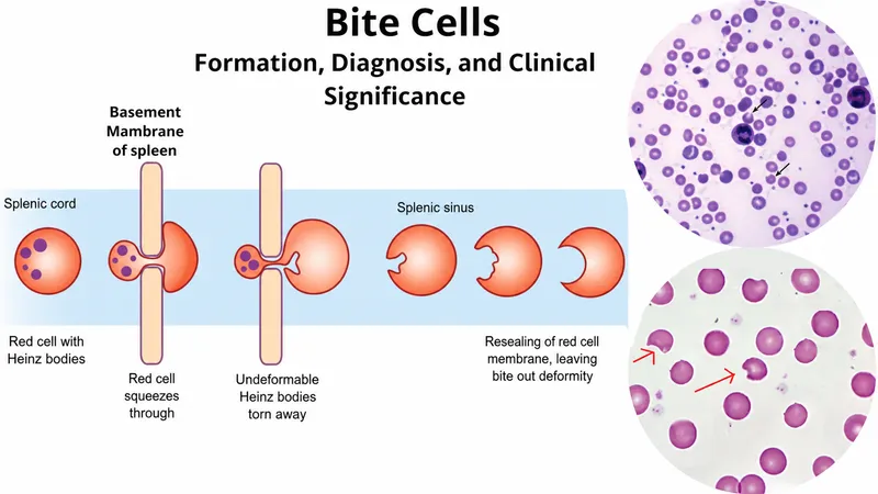 Bite cell formation and appearance in peripheral smear