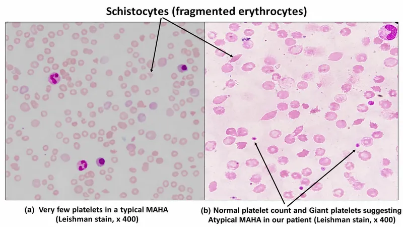 Schistocytes in Microangiopathic Hemolytic Anemia (MAHA)