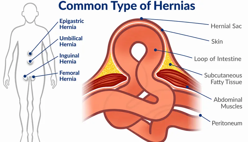 Common Types of Hernias and Anatomy