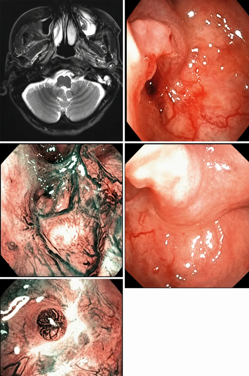 Nasopharyngeal endoscopy showing irregular mass in Rosenmüller fossa with surface ulceration