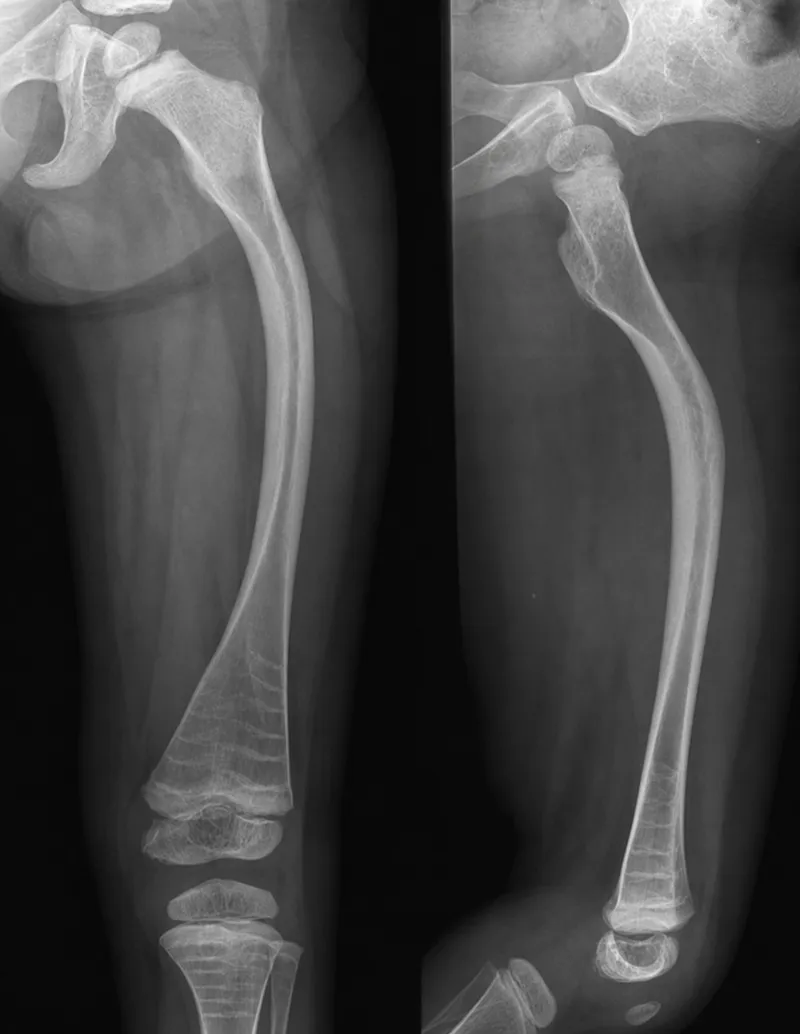 Osteogenesis Imperfecta X-ray: bowing deformity, osteopenia