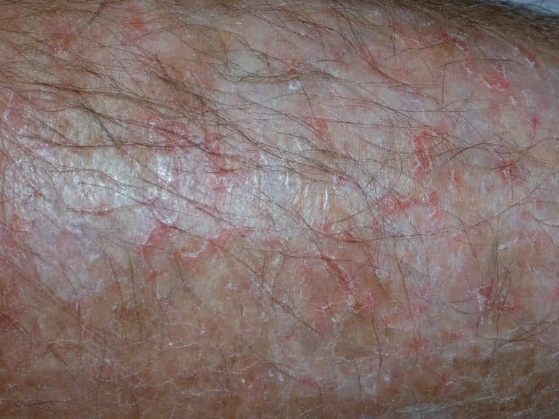 Asteatotic eczema craquelé on elderly leg