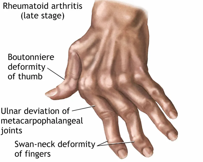 Rheumatoid Hand Deformities