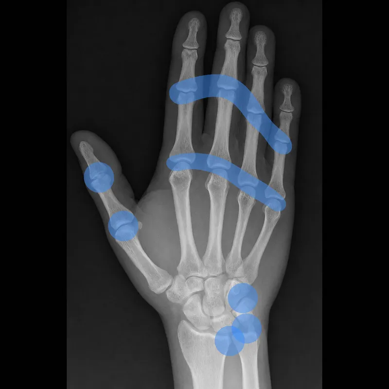 X-ray of hand with rheumatoid arthritis and ulnar deviation