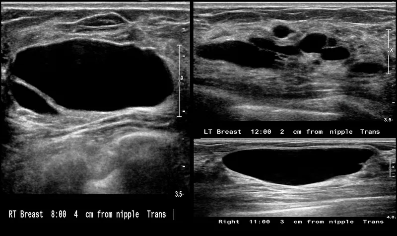Ultrasound: Multiple anechoic cysts