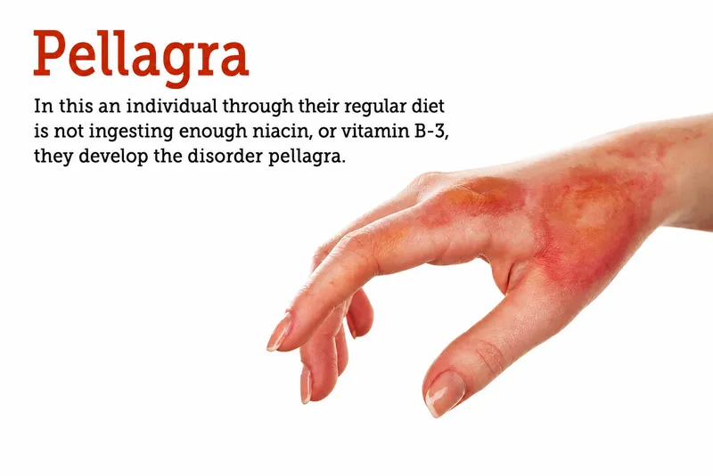 Photosensitive dermatitis on hands showing characteristic pellagra skin changes