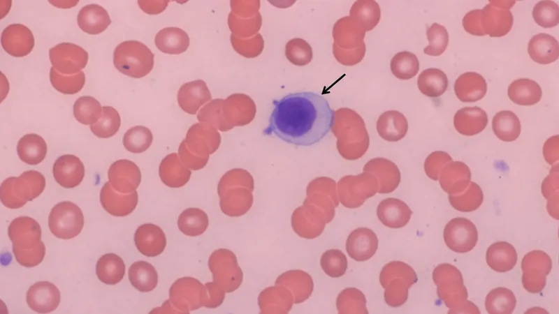 Plasma cell and rouleaux formation in multiple myeloma