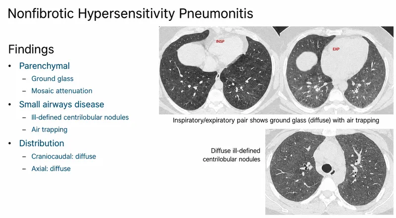 HRCT: Nonfibrotic Hypersensitivity Pneumonitis Findings