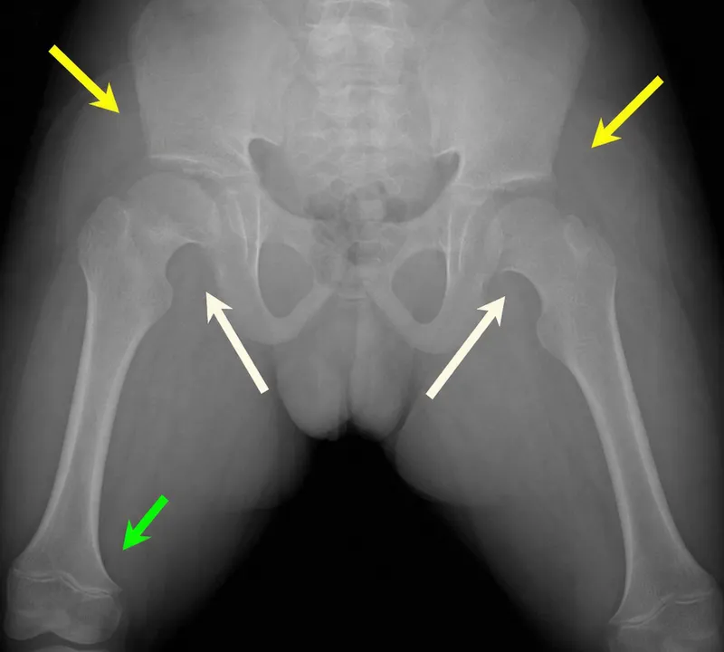 Achondroplasia X-ray: Pelvis and Trident Hand