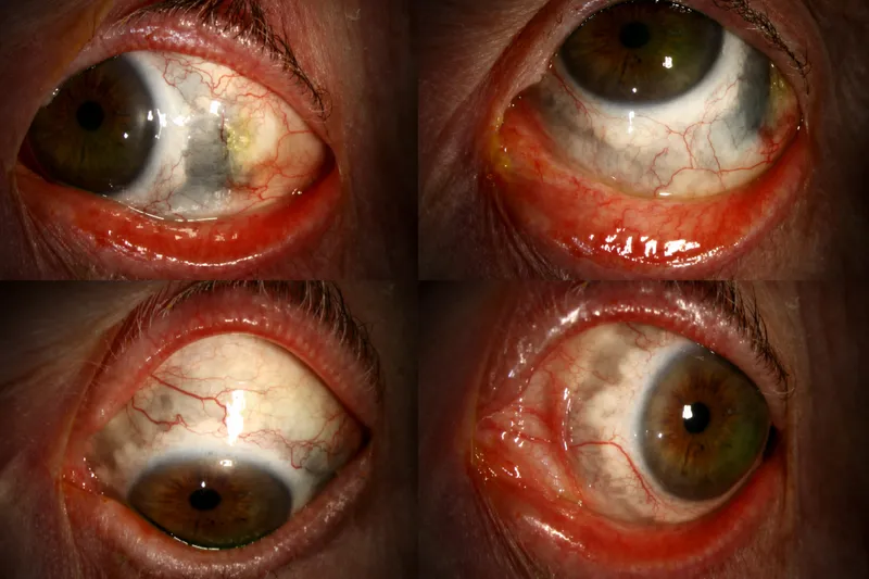 Comparative images showing normal white sclera versus inflamed red scleritis