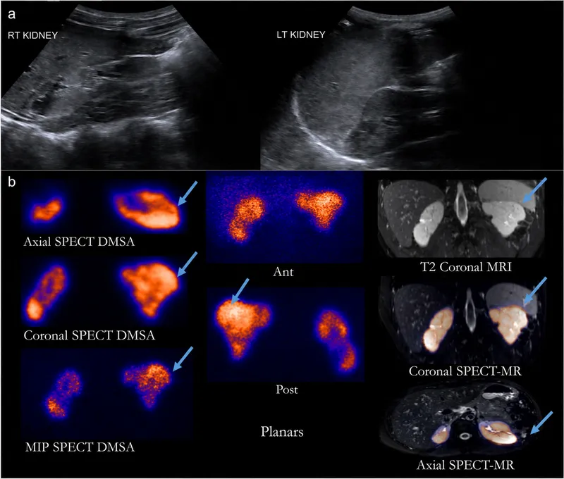 Renal cortical scar on DMSA, MRI, and SPECT-MR