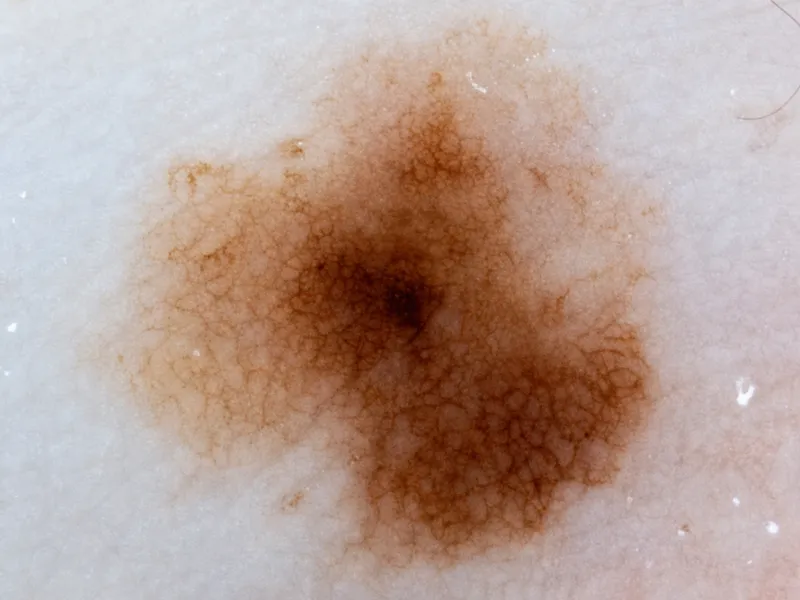 Dermoscopic view of dysplastic nevus