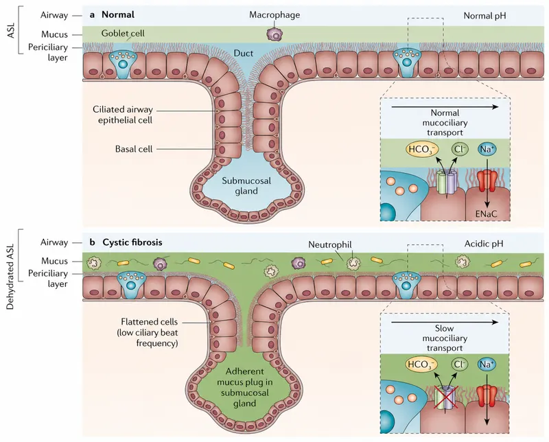CF vs Normal Airway Mucociliary Transport