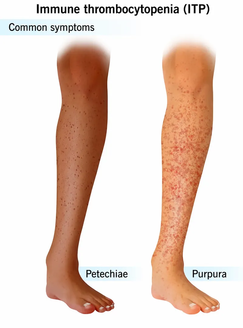 Petechiae and Purpura in Immune Thrombocytopenia (ITP)
