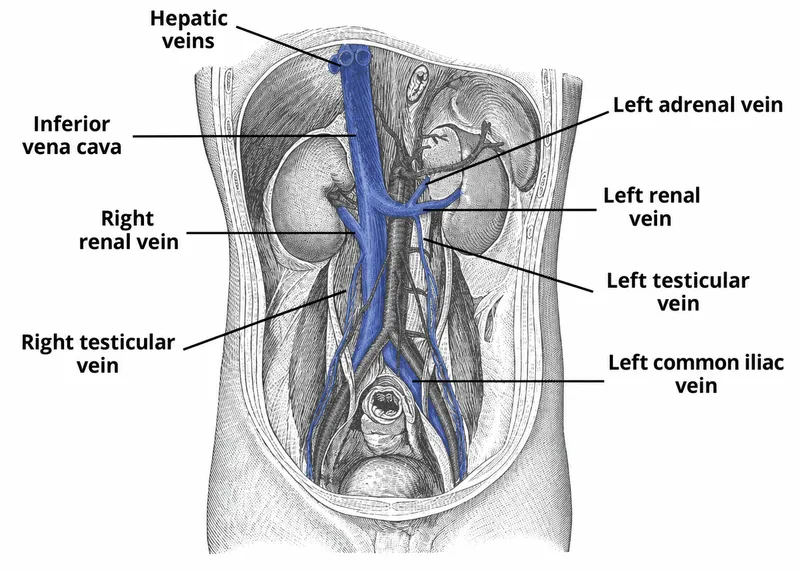 Pelvic Venous Drainage: Iliac, Gonadal, Renal, and IVC