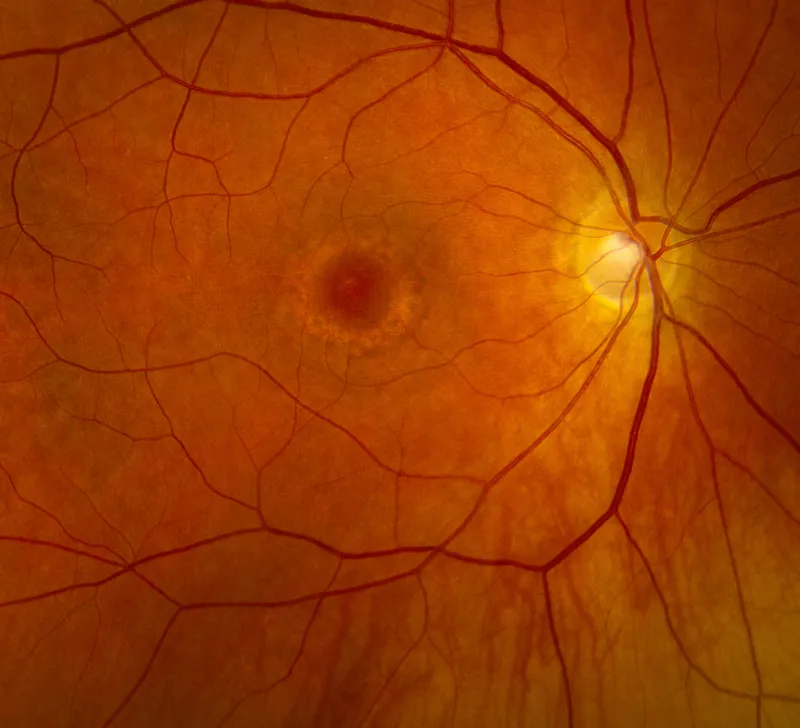 Hydroxychloroquine retinopathy showing bull's eye maculopathy