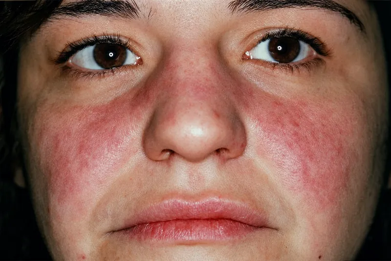 Malar rash in systemic lupus erythematosus