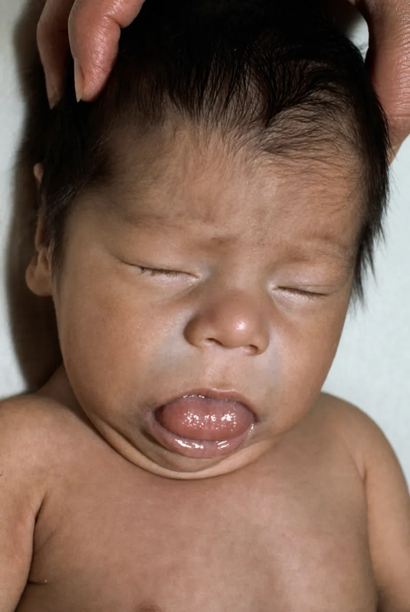 Infant with macroglossia due to congenital hypothyroidism