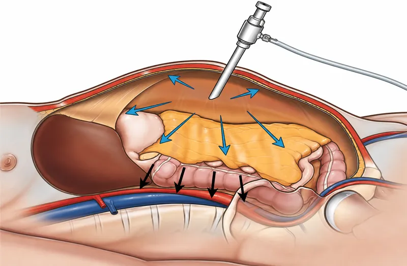 Pneumoperitoneum effects on abdominal organs