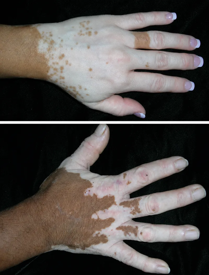 Vitiligo on hands