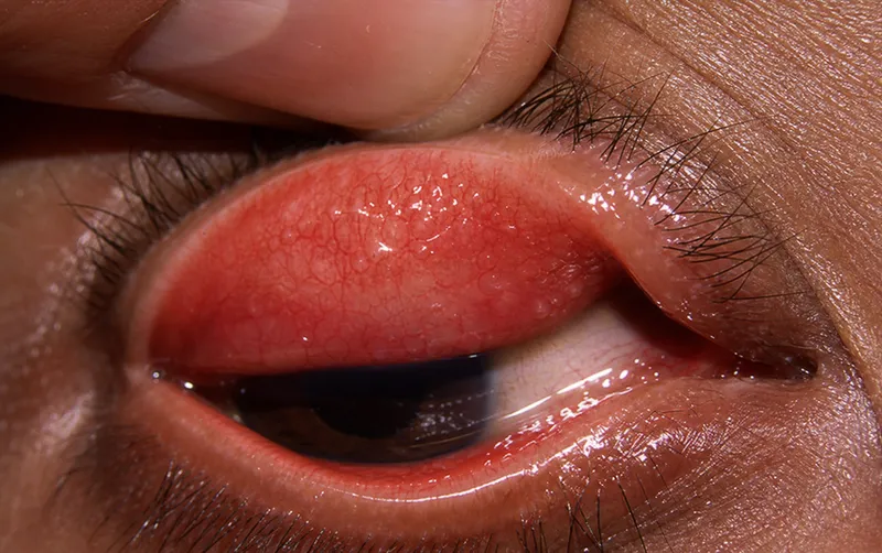 Trachoma: Arlt's line and Herbert's pits