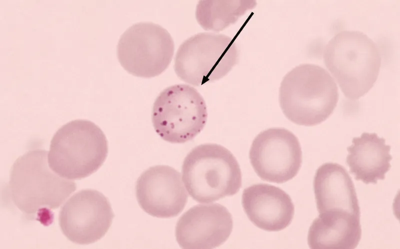 Basophilic stippling in lead poisoning