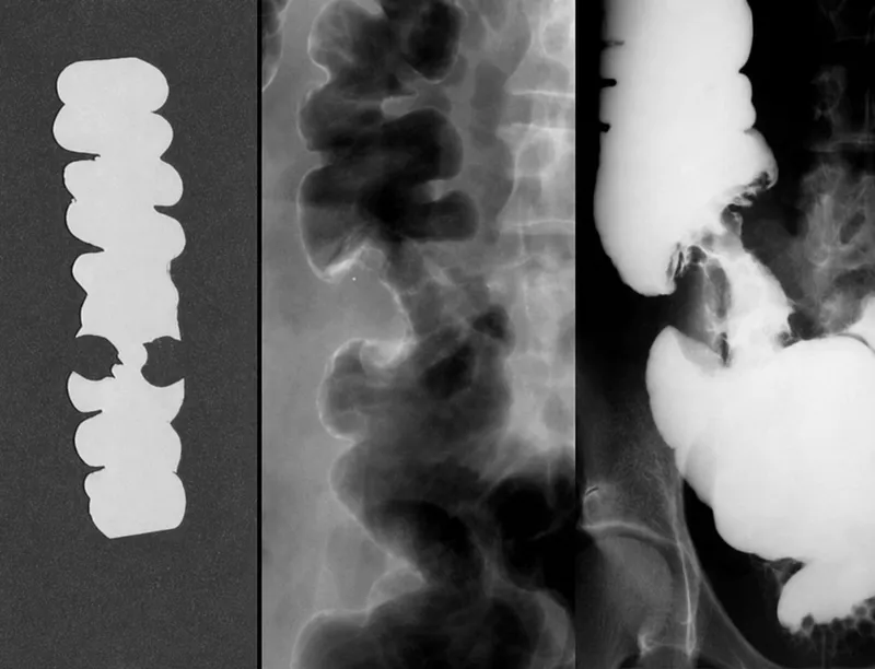 Apple-core lesion on barium enema