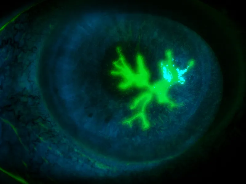 Dendritic ulcer in HSV keratitis