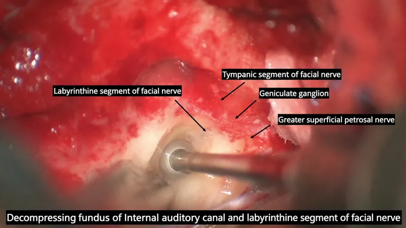 Facial nerve segments for decompression