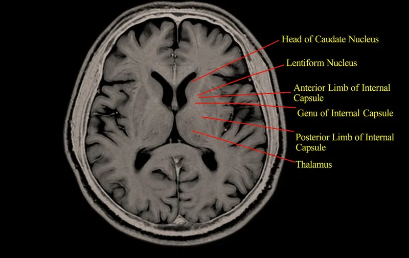 Axial CT brain with basal ganglia and ventricles