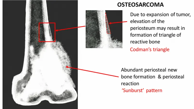 Osteosarcoma X-ray: Sunburst pattern and Codman's triangle