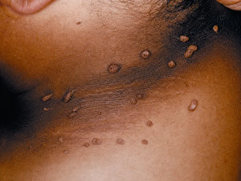 Leser-Trélat sign on neck
