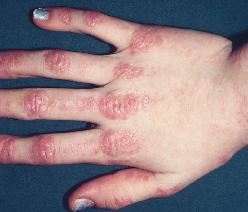 Gottron's papules on hand in dermatomyositis