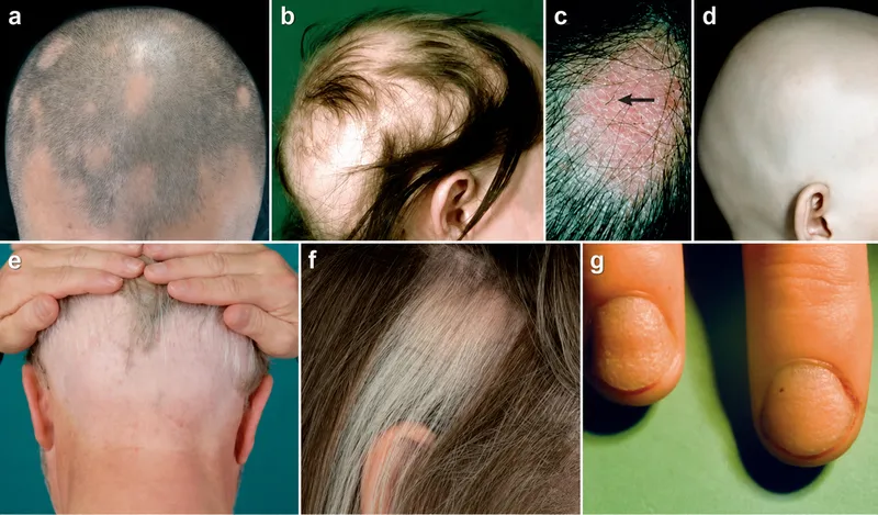 Clinical images of hair and nail disorders