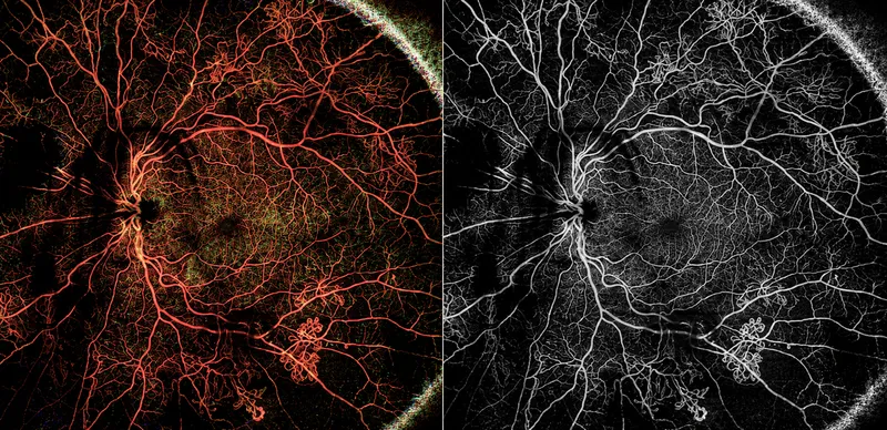 OCT Angiography of Proliferative Diabetic Retinopathy