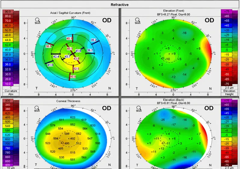 Pentacam 4 Maps Refractive Display