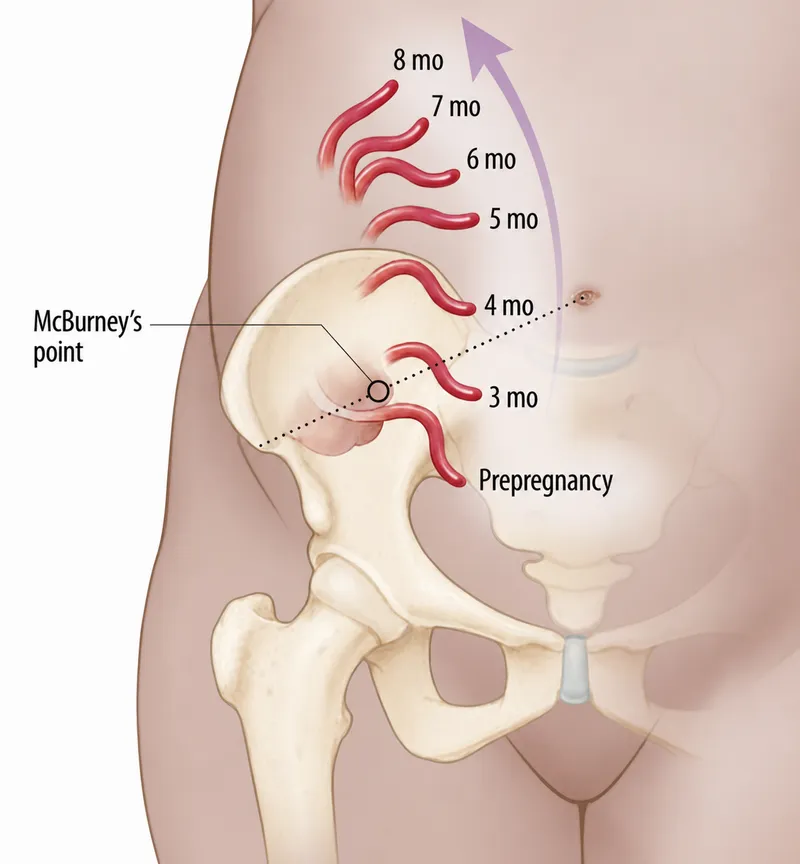 McBurney's point shift in pregnancy