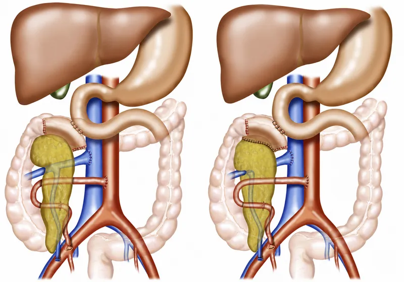 Pancreas transplant graft types with duodenal segment