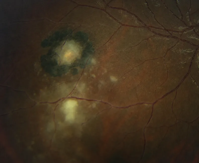 Toxoplasma chorioretinitis showing headlight in fog appearance
